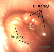 <p>PP: painful+hemorrhagic vesicles on TM±ear canal</p><p>CM: earache<br>blood-tinged discharge<br>conductive hearing loss</p>