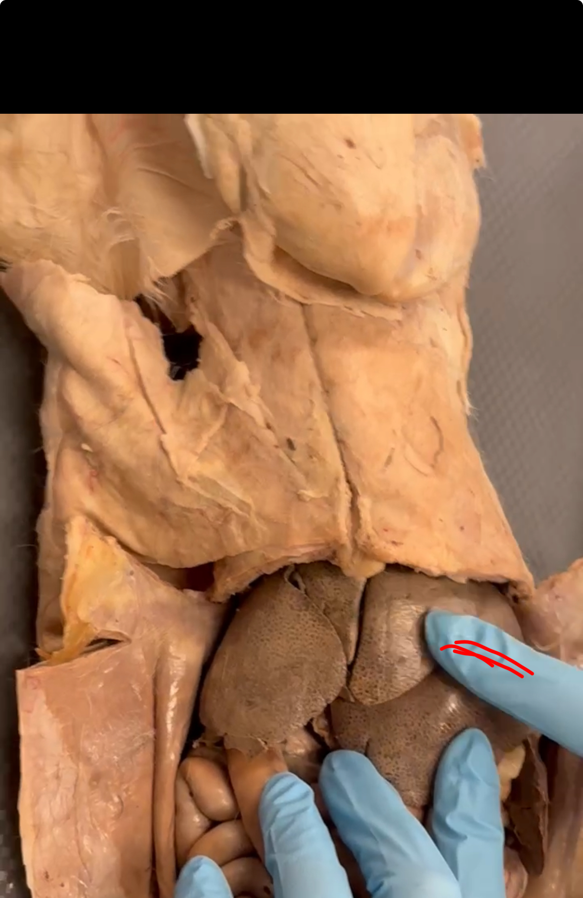 <p>Red finger is touching which lobe</p>