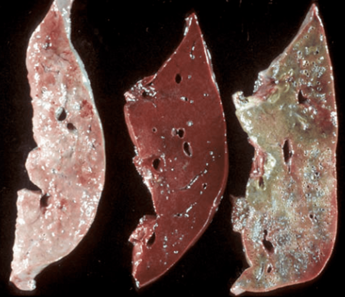 <p>What type of imbibition is shown in this image?</p><p>Hemoglobin or Bile?</p>