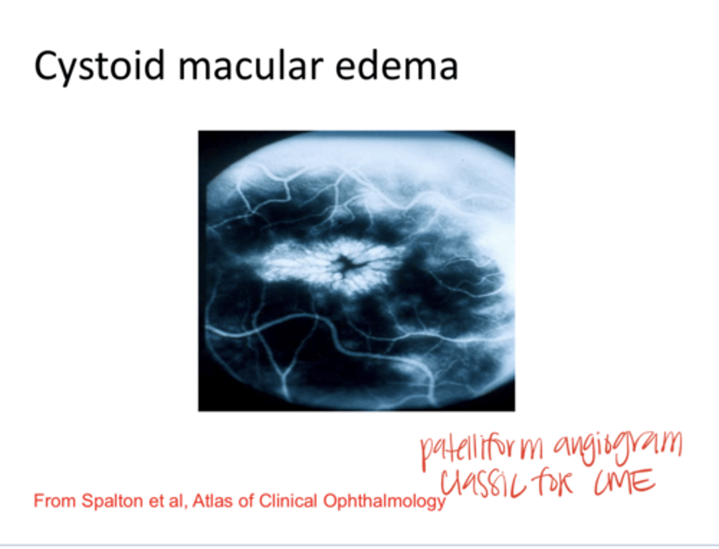 <p>Cystoid Macular Edema on FA -- Petalliform Appearance (Pic)</p>