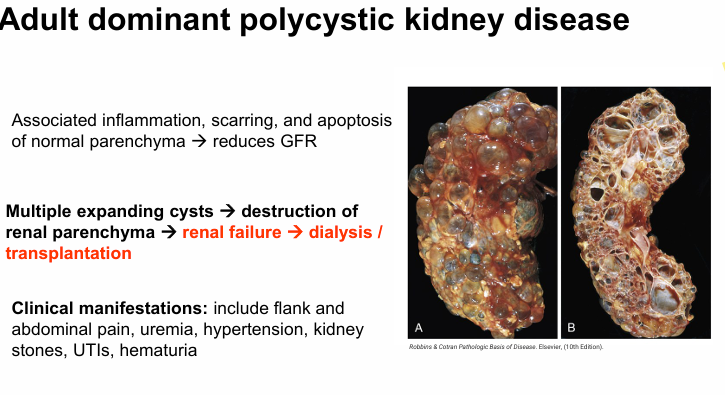 <p>-genetic autosomal<br>-cysts not at birth → slowly develo<br>-kidney function normal until 40-50yrs</p>