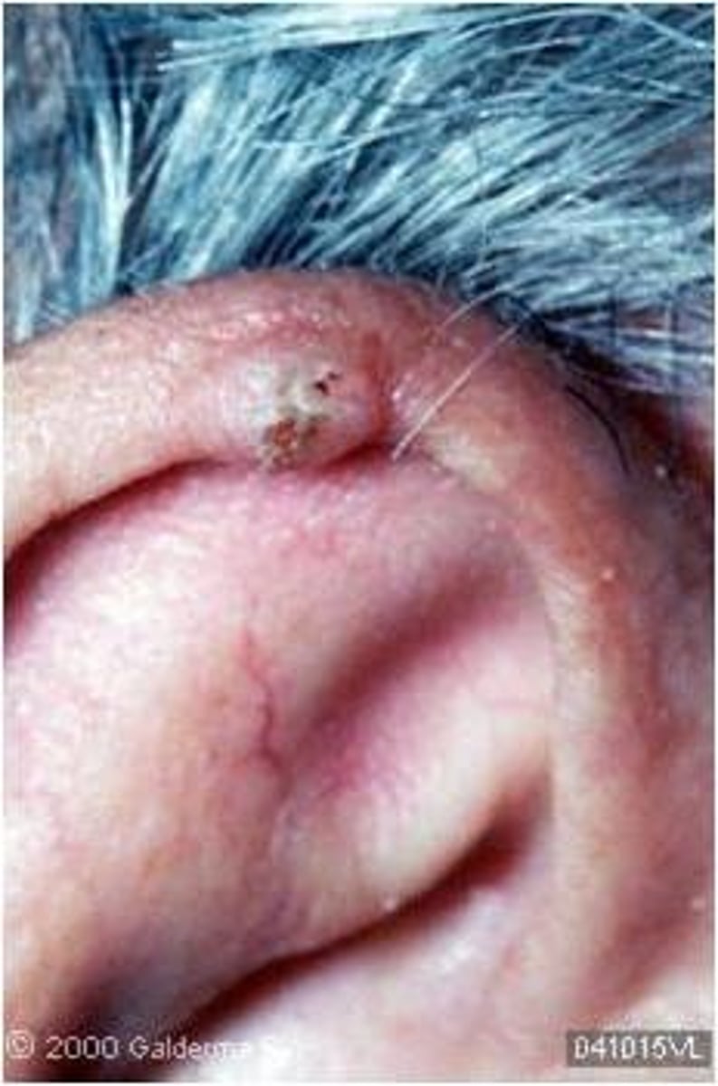 <p>benign, painful nodule on helix looks like BCC/SCC</p>