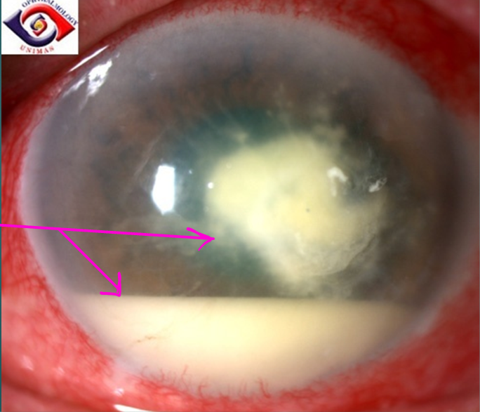 <p>Ulceration of cornea; infiltrates, surrounding edema</p><p>Anterior chamber reaction with or without hypopyon</p><p>Eyelid edema</p><p>Corneal haze</p><p>Conjunctiva hyperemia</p><p>Mucopurulent exudate</p>