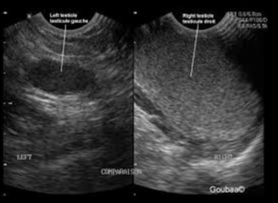 <p>What is <strong>a congenital absence of testicle</strong>?</p><p>•Rare, accounts for only 4% of pts with cryptorchidism</p><p>•May need patient to have full bladder to aid in finding an undescended testicle</p><p>–MRI and CT help</p>