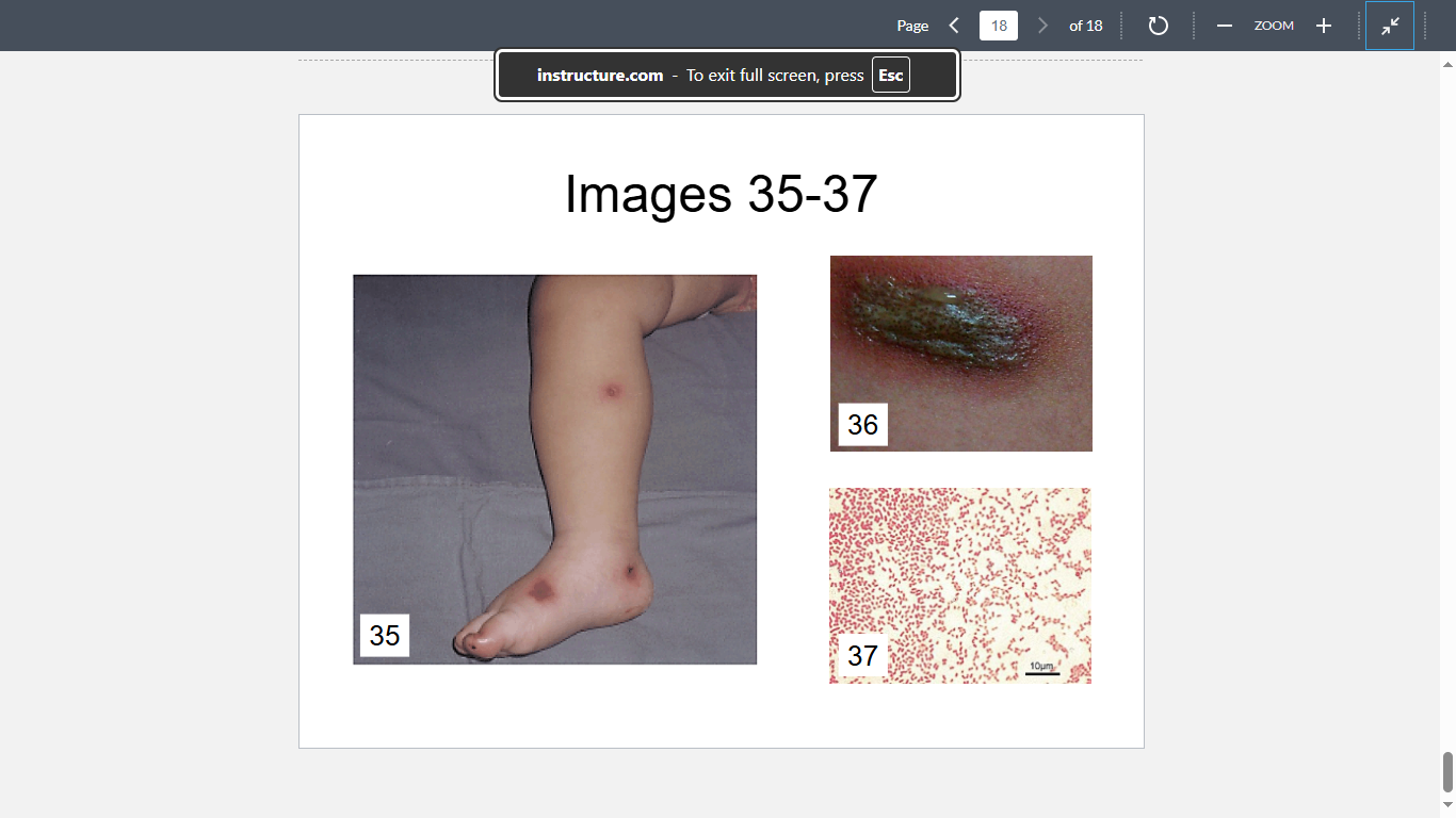 <p>A 4-year old girl, who was on chemotherapy for her acute myelogenous leukemia, has developed severe neutropenia, fever and skin lesions (see Images 35 & 36). Cultures of the lesion and blood specimen yield organisms (Image 37) that are oxidase positive and produce fruity odor. What is the most likely diagnosis?</p>