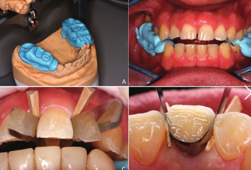 <p><strong>Occlusal stops</strong> are specific points of contact between the upper and lower teeth that help maintain proper bite alignment and stability. They play a crucial role in <strong>preventing excessive movement</strong> and ensuring that dental restorations, such as crowns or dentures, function correctly.</p><p></p><p>placed in strongest contact area </p>