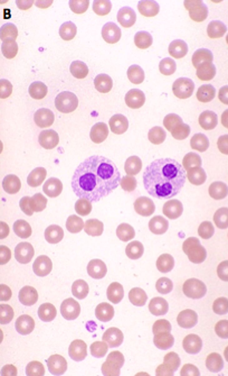 <p>myeloproliferative state, hypo granular, intense clumping, round nucleus</p>
