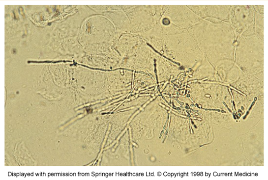 <p>white “curd-like” discharge in vulva</p>