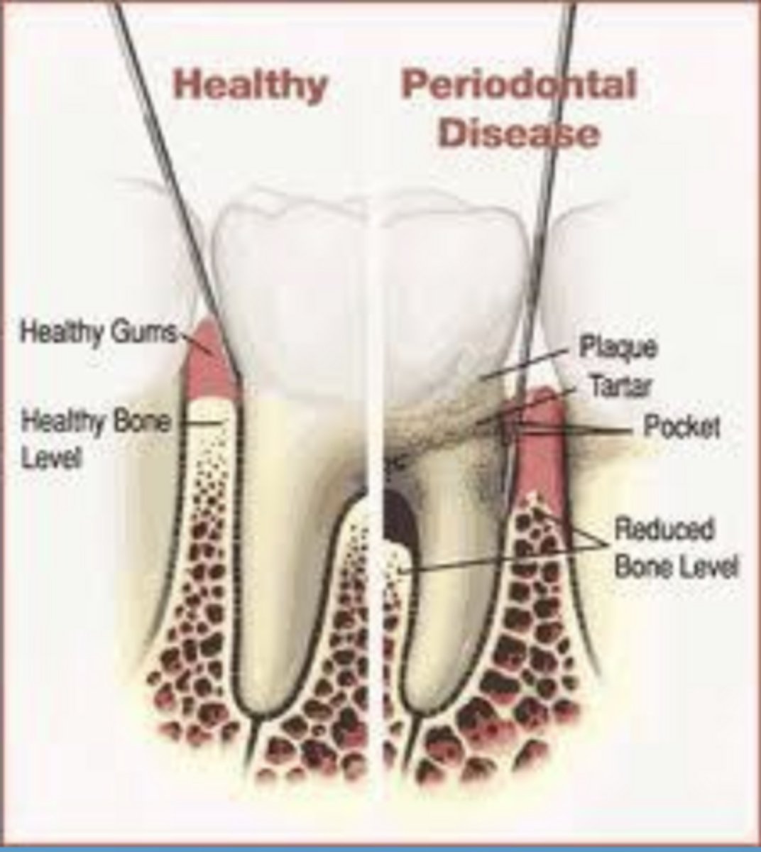<p>subgingival, immune-inflammatory</p><p>*need control of inflam response to decrease colateral damage*</p>