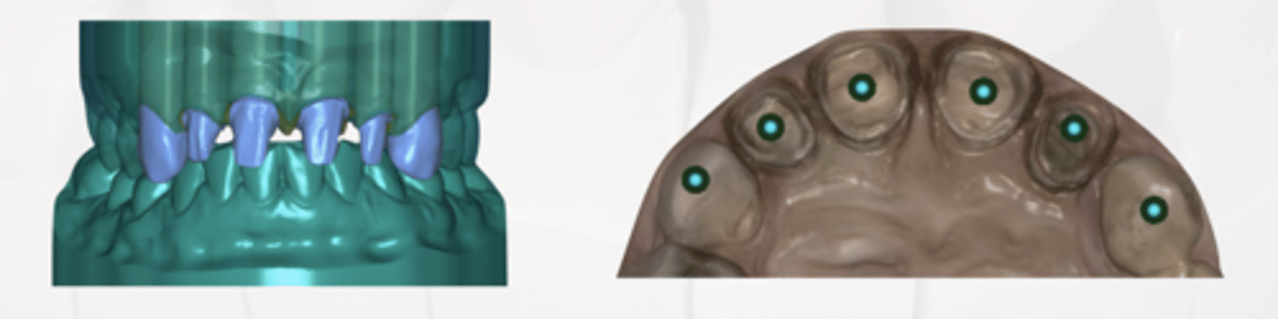 <p>Define the following:</p><p>Refers to the process of creating space or clearance around specific areas of a dental model to accommodate restorative materials like crowns or bridges</p>