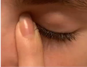 <p>occlusion of the nasolacrimal duct </p>