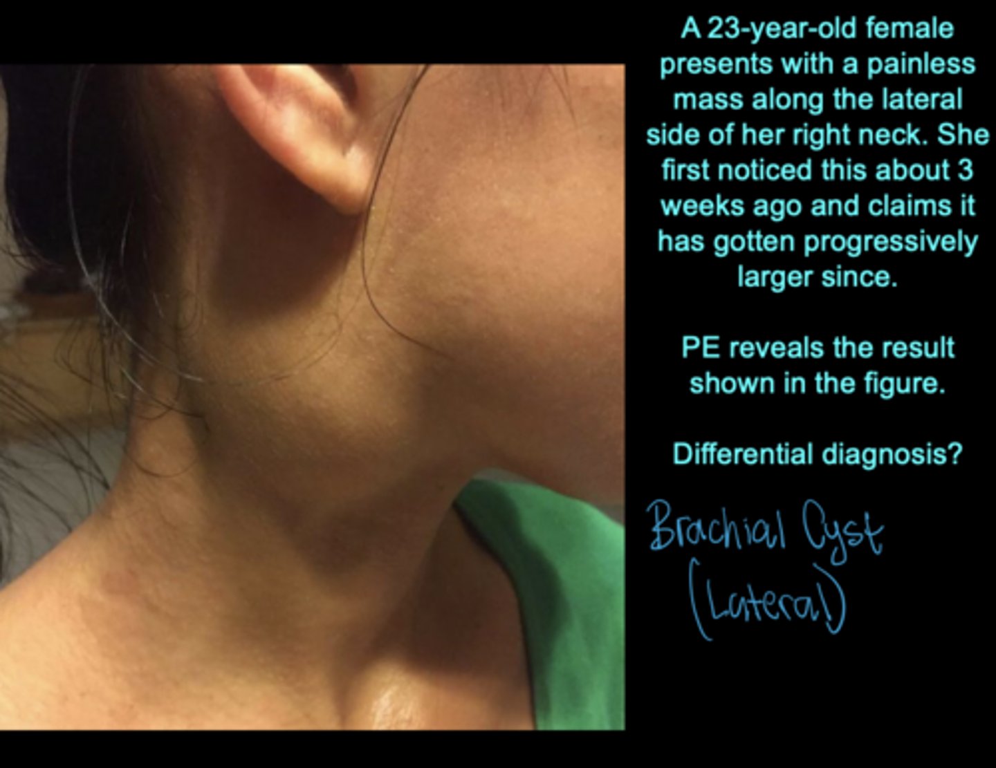 <p>Persistence of pharyngeal grooves occur when the second arch fails to grow over the third and fourth arches. Such a defect results in the formation of a lateral cervical cyst; fistulas have an external opening on the lateral aspect of the neck</p>