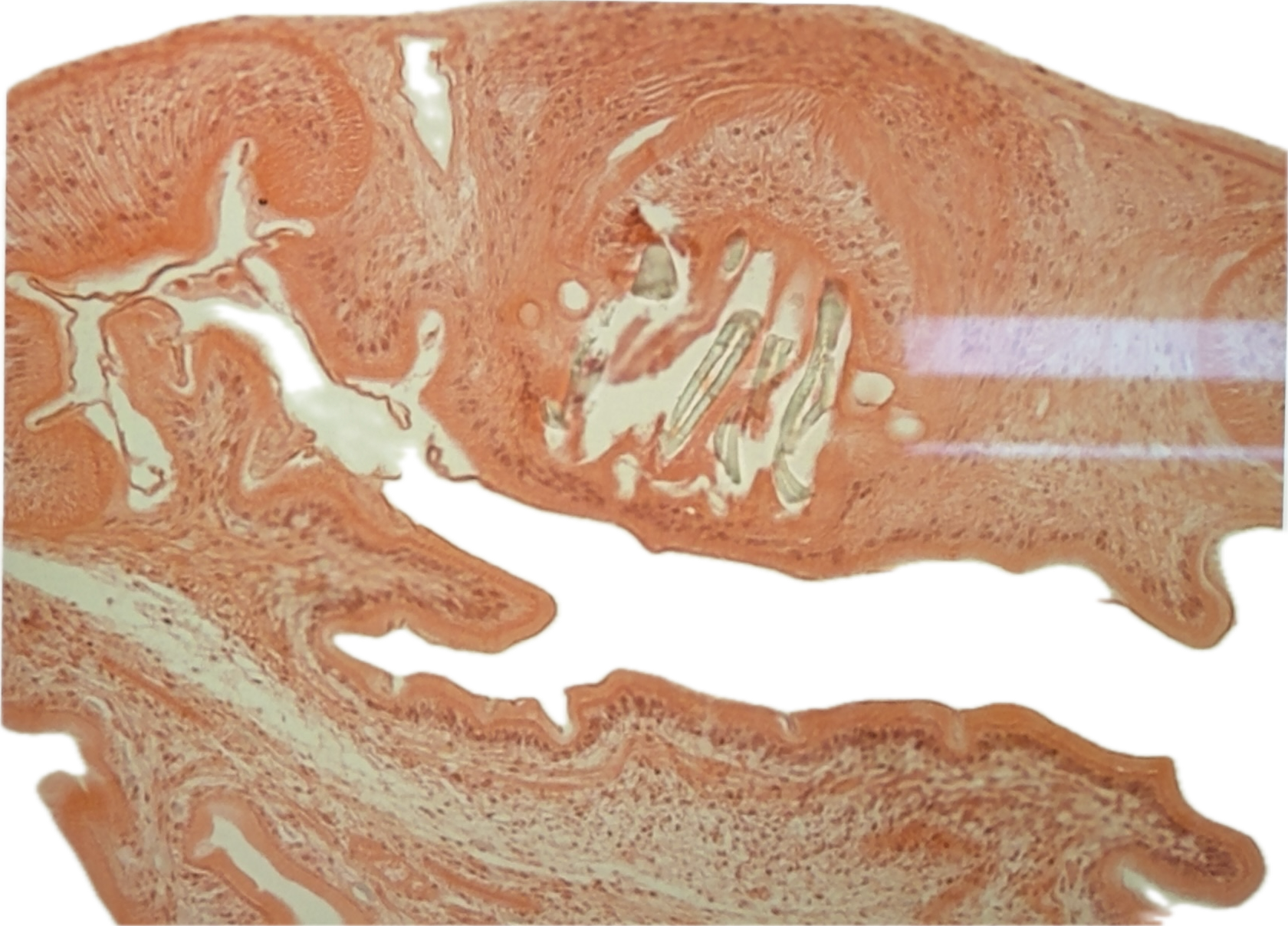 <p><span style="color: rgb(0, 0, 0)">A 33-year-old man with new-onset seizures has a 3-cm cystic brain lesion. Histology shows a cyst with an invaginated scolex containing hooklets and suckers.</span><br><strong>Question:</strong><span style="color: rgb(0, 0, 0)">&nbsp;What is the most likely diagnosis?</span></p>