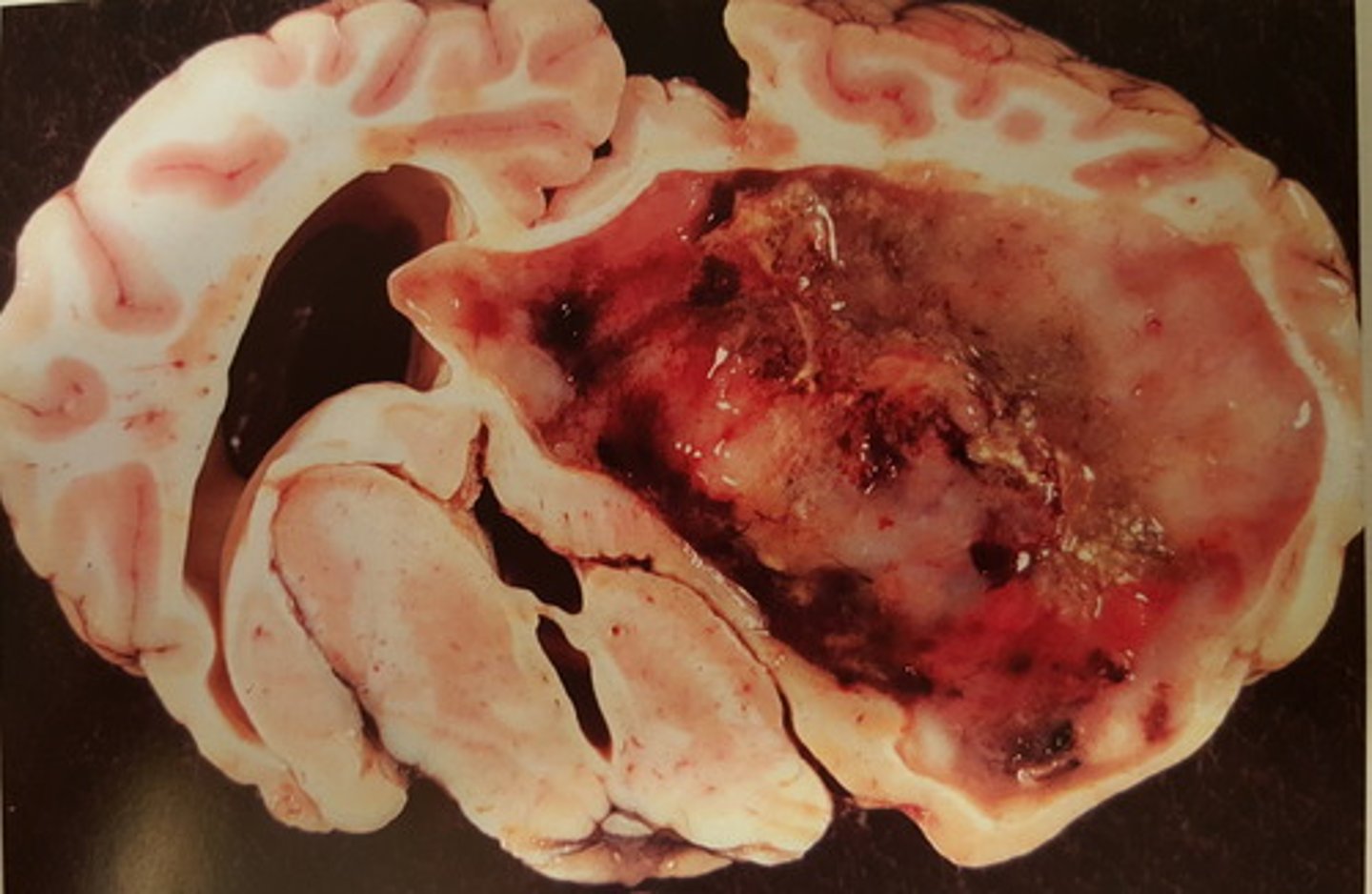 <p>Hjerne fra okse. Patoanatomisk diagnose?</p>