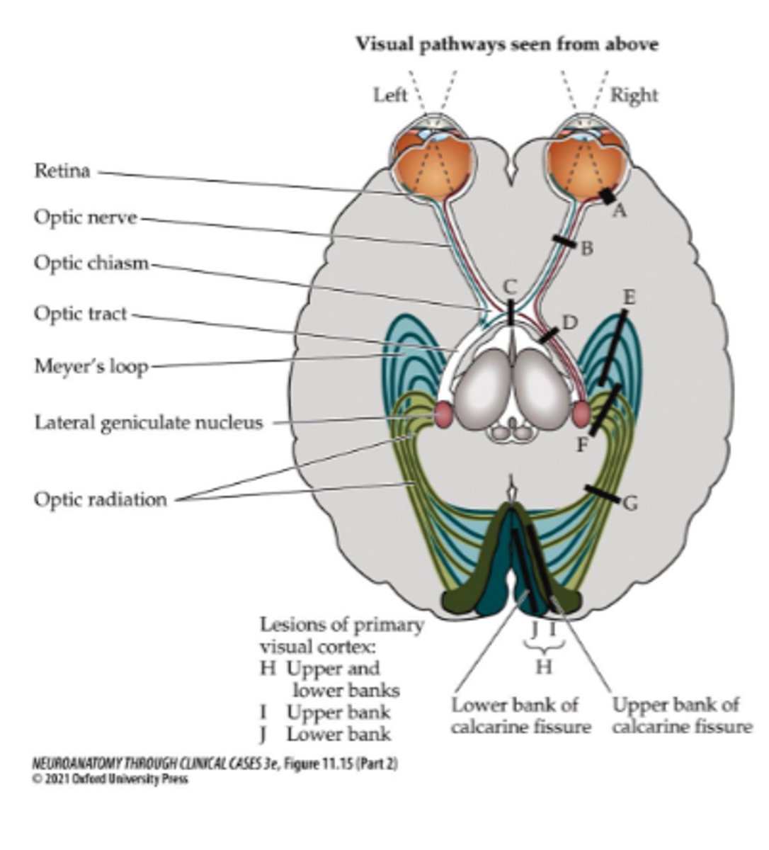 <p>Right superior bank of calcarine fissure</p>