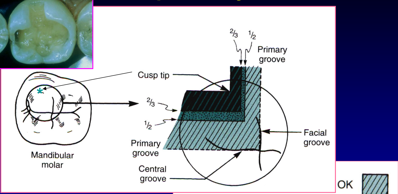 <p>if it is less than ½ depth into the tooth </p>