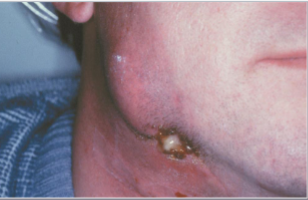 <p>sulfur granules in pus </p>