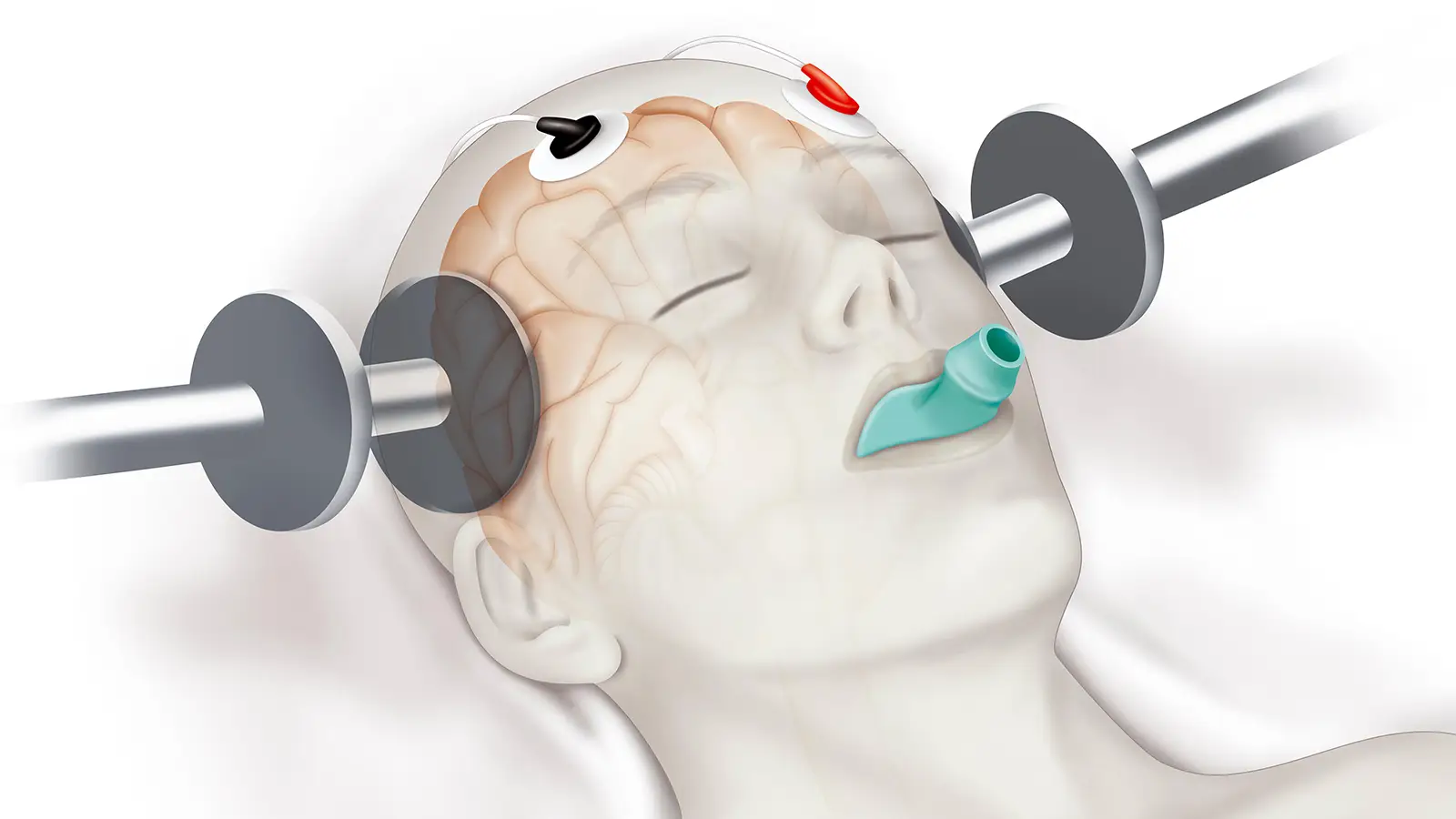 <p><span>is a medical treatment where small electrical currents are passed through the brain to trigger a brief seizure.</span></p>