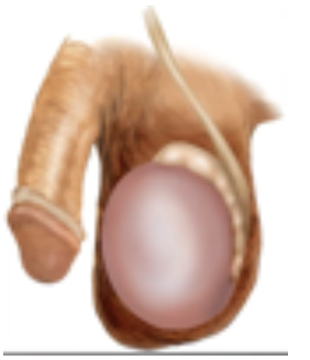 <p>Inflammation of one or both testicles</p>