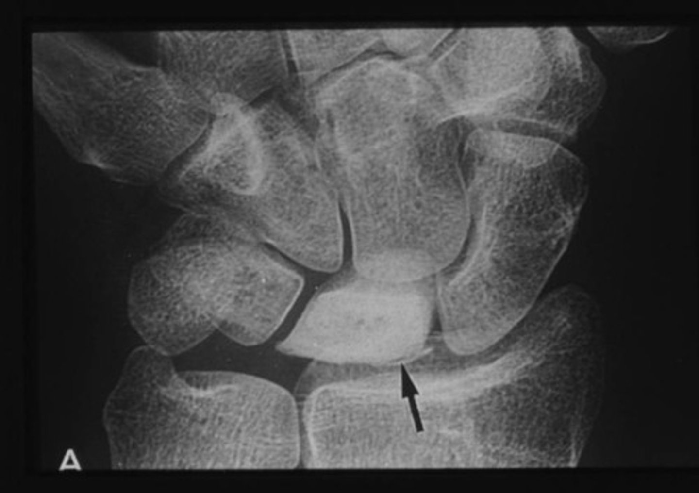 <p>bones poorly mineralized; calcium salts not adequate; soft, weak bones but bone density may be normal; pain upon bearing weight</p>