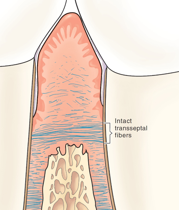 <p>resilient bands of gingival ligament fibers that run from one tooth to another across the crest of the bone (can usually withstand periodontal inflammation)</p><p>if inflamm is severe enough to overcome this, tooth displacement/pathologic tooth migration occurs</p>