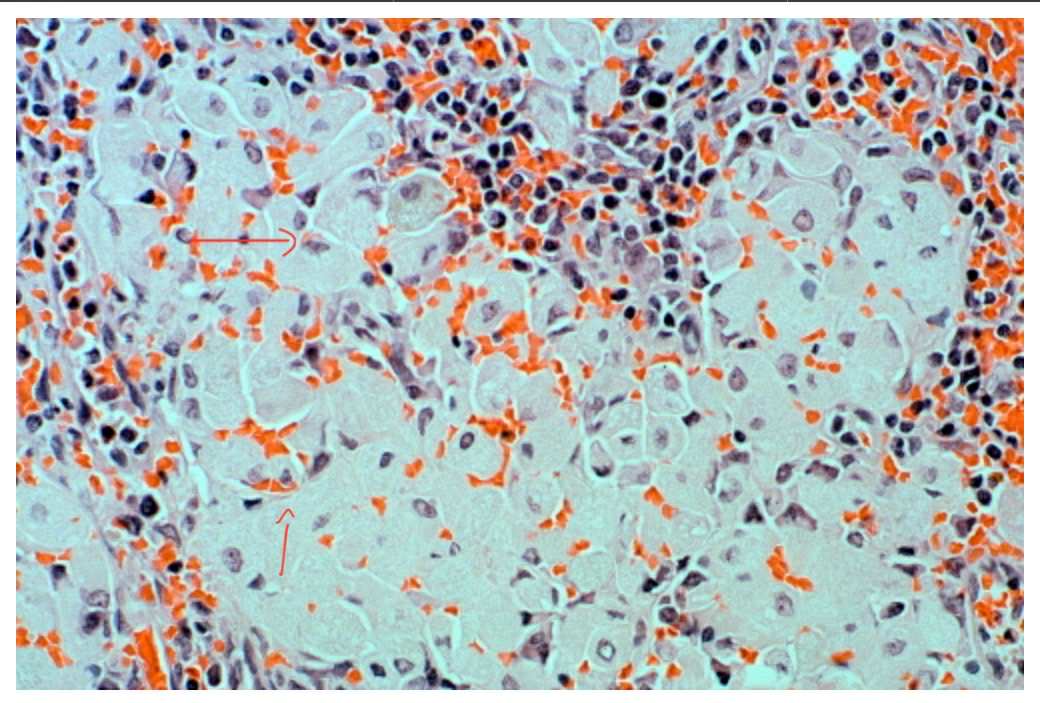 <p>A histological section of the spleen with Gaucher disease. The large pale cells pointed are accumulated storage product. What enzyme is deficient in this condition?</p>