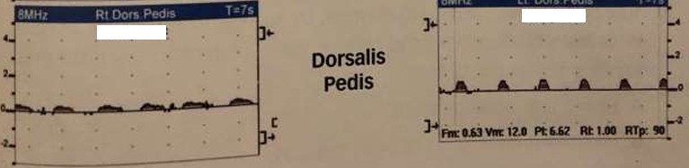<p>What do the dorsalis pedis artery waveforms most likely represent? </p><ul><li><p>Describe L &amp; R waveforms</p><ul><li><p>If diseased, where disease is located and if it is inflow/outflow disease</p></li></ul></li></ul><p></p>