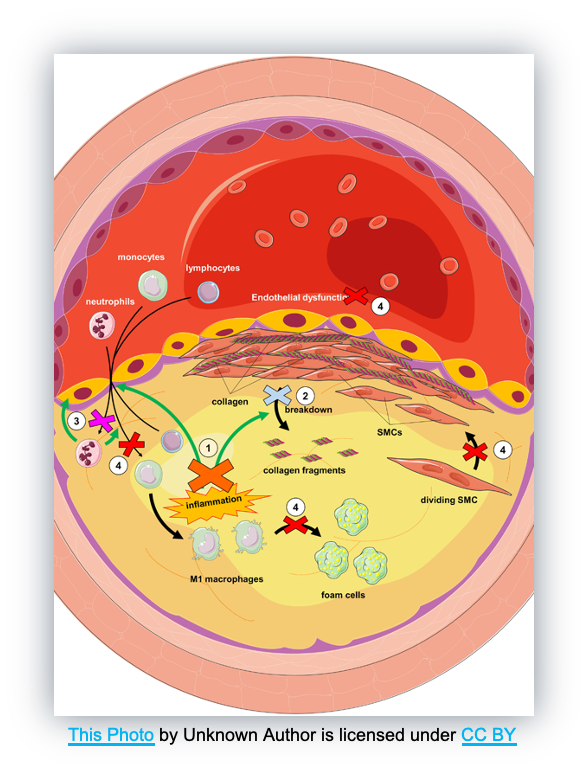 <ul><li><p>Hypercholesterolemia&nbsp;</p></li><li><p>Elevated LDL</p></li><li><p>Age</p></li><li><p>Family history&nbsp;</p></li><li><p>Biological males</p></li><li><p>Smoking&nbsp;</p><ul><li><p>Vasoconstriction</p></li><li><p>Damages endothelial lining </p></li></ul></li><li><p>Obesity&nbsp;</p></li><li><p>Hypertension&nbsp;</p></li><li><p>Diabetes&nbsp;</p></li></ul><div data-type="horizontalRule"><hr></div><ul><li><p>Atherosclerosis:</p><ul><li><p>Cellular injury in smooth endothelial wall</p></li><li><p>Inflammatory cells are attracted to the area and gather</p></li><li><p>Causes gathering of lipids and smooth muscle tissue that begin to collect</p></li><li><p>Lipids/smooth muscle form a hard plaque in the vessel</p></li></ul></li></ul><p></p>