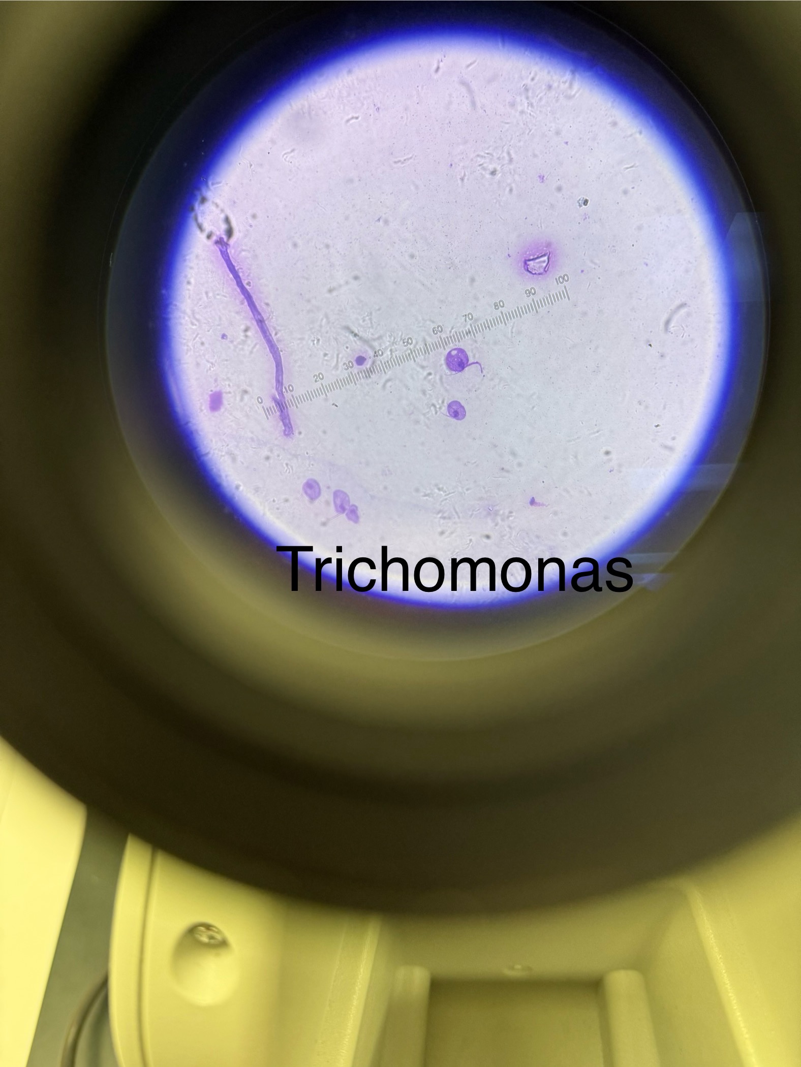 <p>Domain: Eukarya</p><p style="text-align: start">Kingdom: Protista</p><p style="text-align: start">Phylum: Archaezoa</p><p style="text-align: start">Genus: Trichomonas</p><p style="text-align: start">Species: vaginalis</p><p style="text-align: start">Causes sexually transmitted disease/infection</p><p style="text-align: start">Lacks mitochondria and must live in an animal host</p>