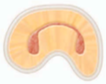 <p><span>characterized by</span><span style="color: red;"><span> two canals</span></span><span> with a </span><span style="color: red;"><span>definite connection </span></span><span>between them (complete isthmus)</span></p>