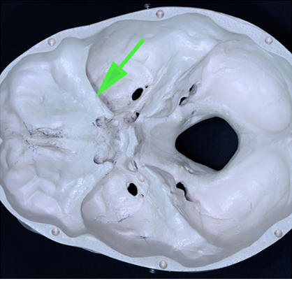 <p>What part of the sphenoid bone is marked by the green arrow?</p>