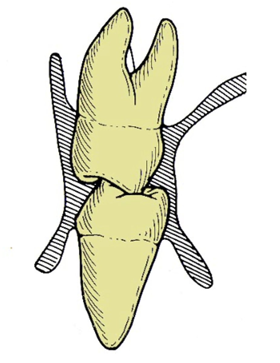 <p>What muscle is indicated in grey, lateral to the posterior teeth?</p>