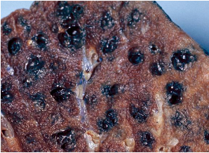 <p>enlarged, overinflated alveoli, air bubbles in interlobular septa or subpleura </p>