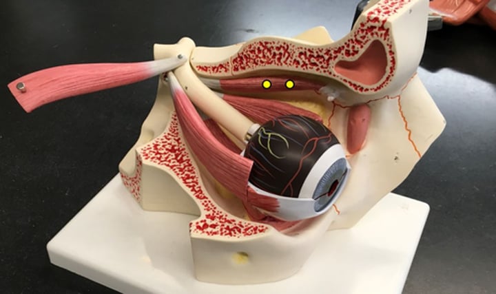 <p>Muscle that is more medial and connects to the trochlea of the eye</p>