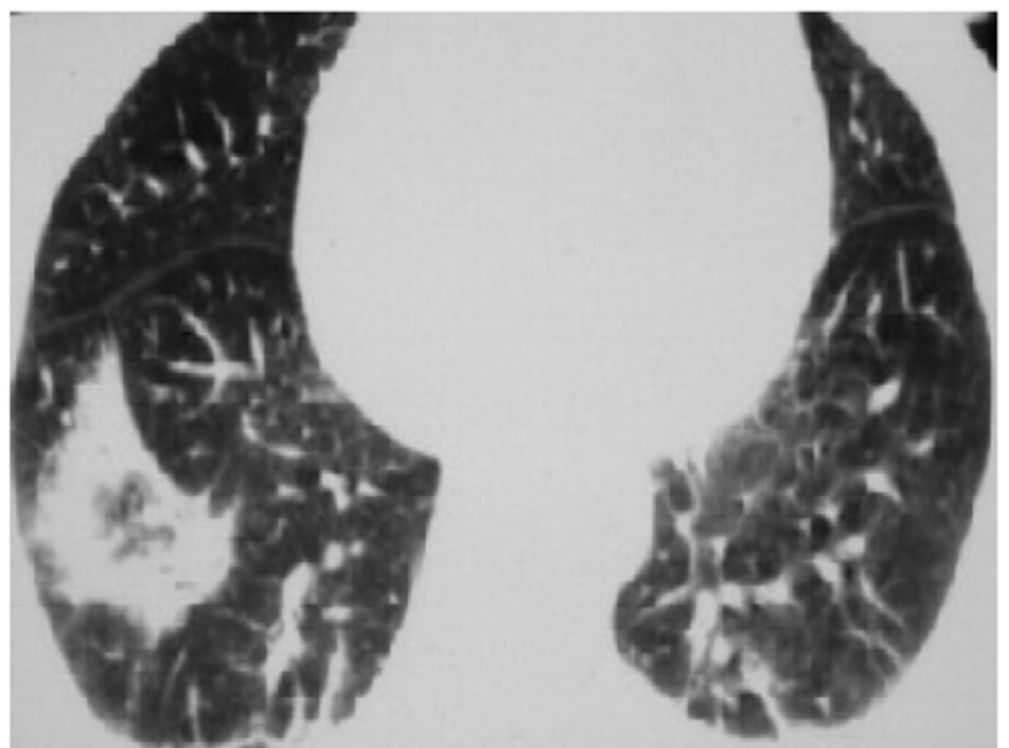 <p>42 yr old female presents with a cough and is felt to have worsening pneumonia</p><p>-never smoked</p><p>-treated empirically for bonchitis</p><p>-pt presents with pleuritic chest pain weeks later</p><p>• Bronchial Alveolar Lavage and transbronchial biopsy reveal atypical mucin laden cells</p>