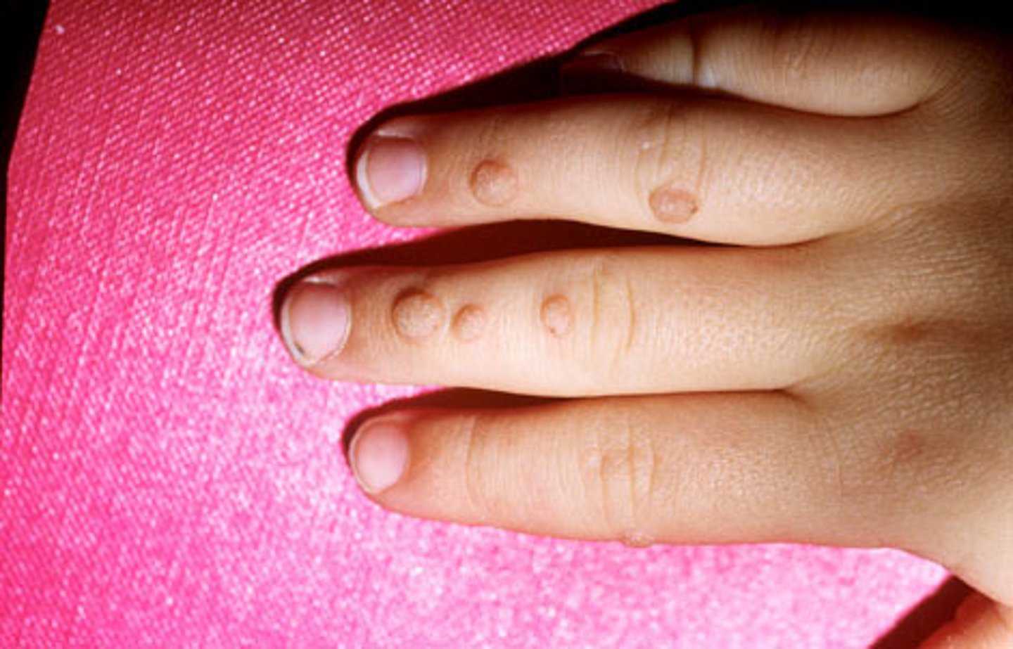 <p>dome shaped with irregular surfaces, common in children</p>