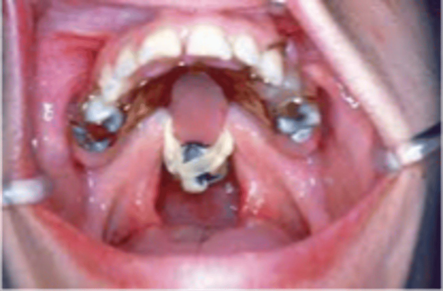 <p>Replaces anatomy of the head and neck beyond teeth and periodontium and/or helps aid in function due to lost anatomical structures</p><p>ex:</p><p>-Anaplasties (silicone)</p><p>-Obturator</p><p>-Speech Aid appliances</p><p>-Mandibular Resection Prosthesis</p>
