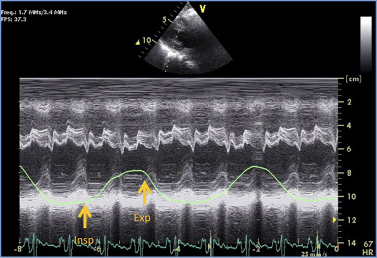 <p><span><span>The M-Mode demonstrates and is an example of what cardiac pathology?</span></span></p><p>Constrictive Pericarditis</p><p>Acute pericarditis</p><p>Pulmonary hypertension</p><p>Dressler's syndrome</p><p>RVVO</p>