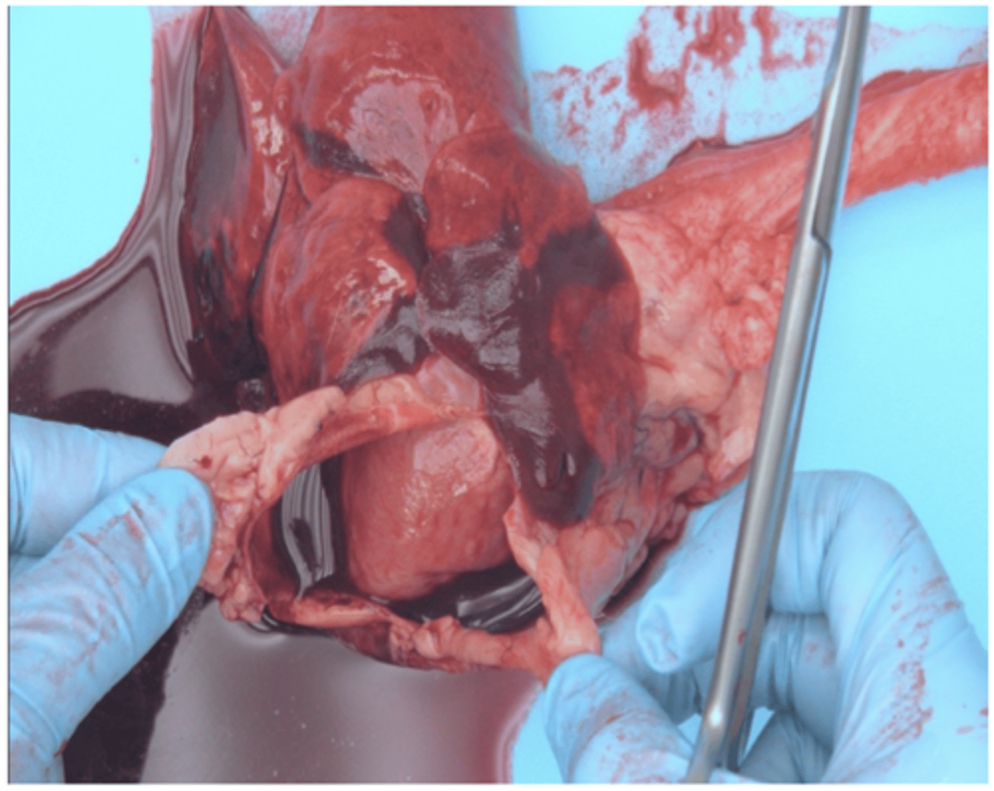 <p>Blood in the pericardial cavity</p>