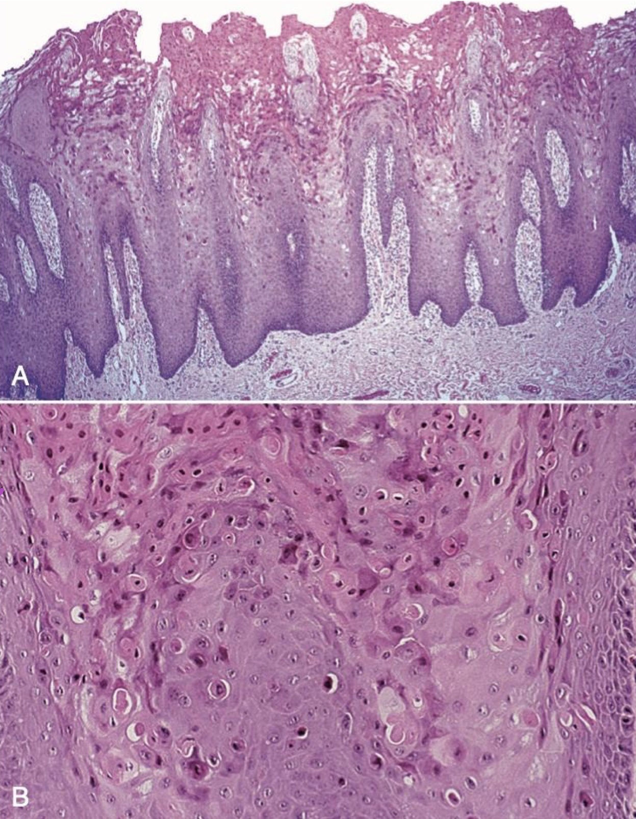 <p>cell w/in cell appearance hereditary </p>