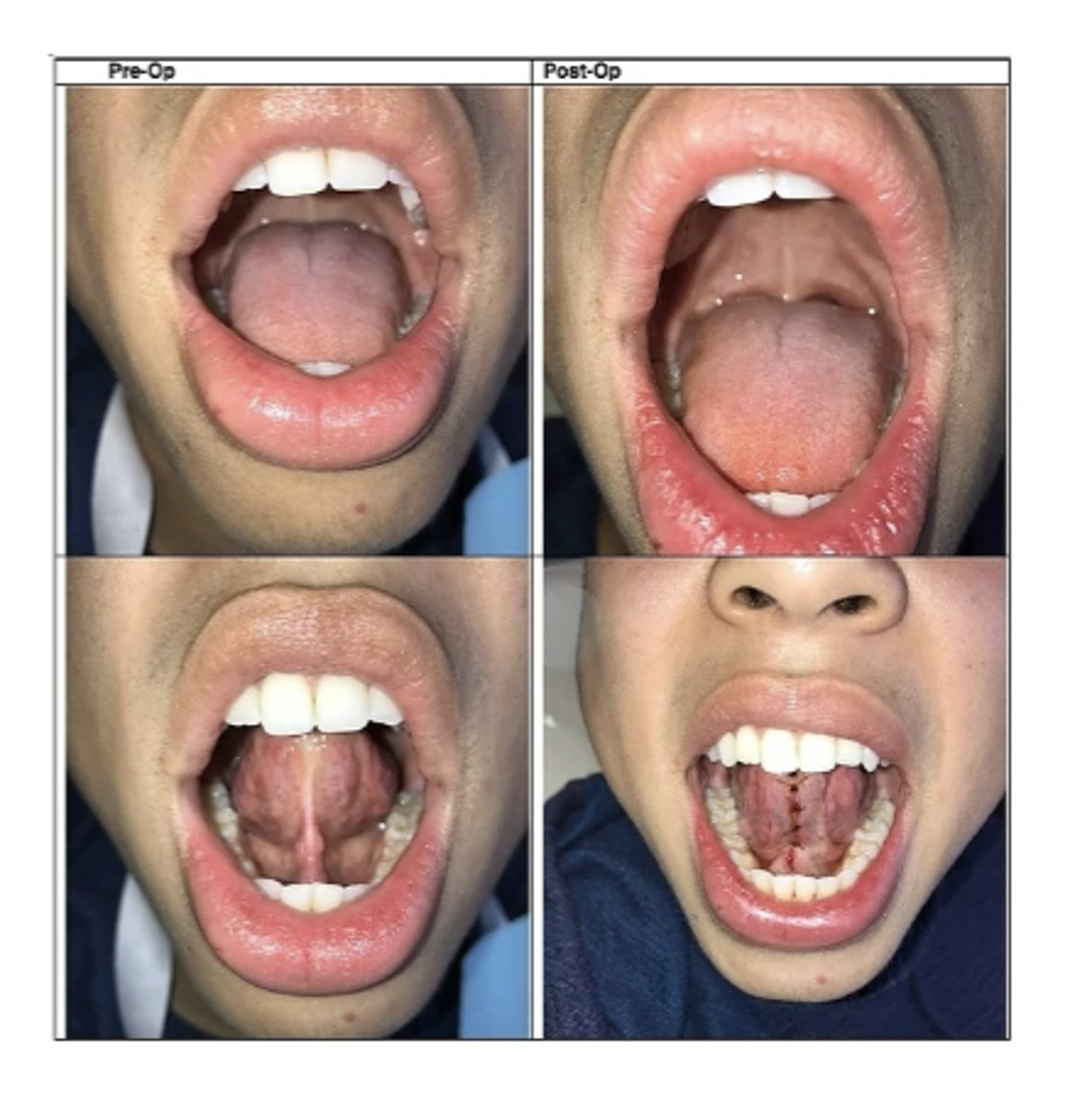 <p>What is the treatment for Ankyloglossia in severe cases for 4-5 year old children or Adults? </p>