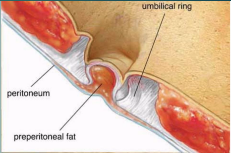 <p>a defect in the linea alba and is located under the umbilicus This is the area where the umbilical vessels passed to and from the umbilical cord and placenta</p>