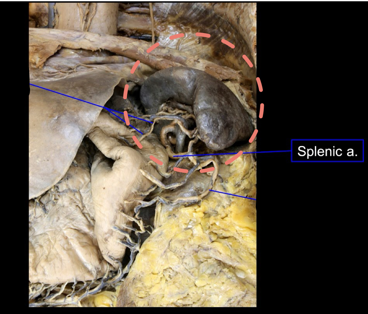 <p>A). Spleen<br>B). splenic artery</p>