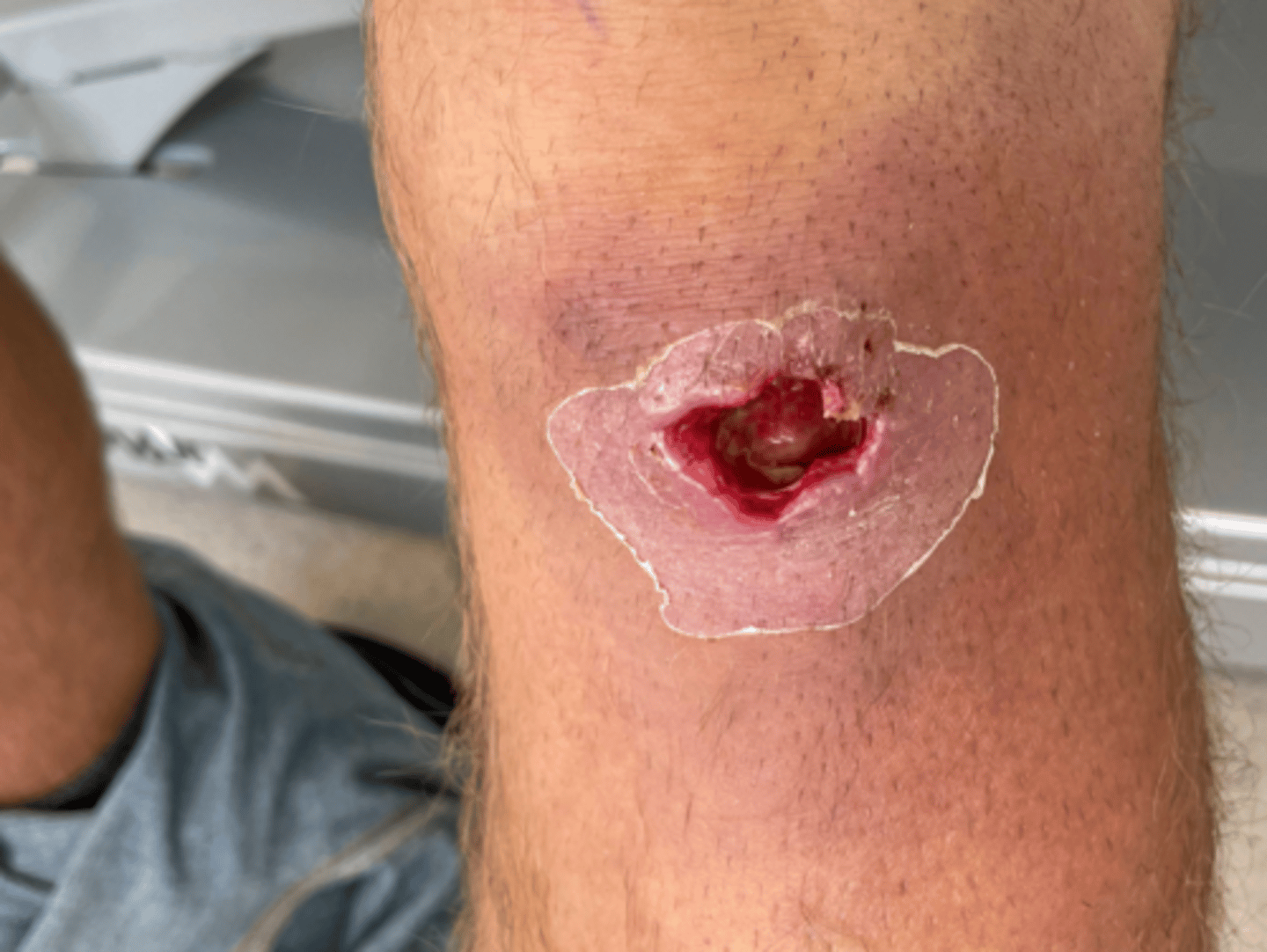 <p>Wound healing is delayed and occurs when the wound that was previously open is now closed. This process is usually associated with large infected and contaminated wounds.</p>