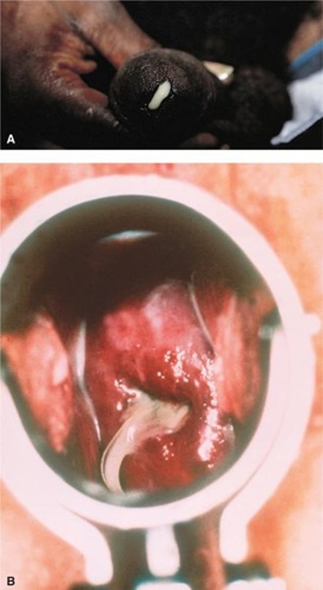 <p>Common symptom of gonorrhea in men, purulent in nature.</p>