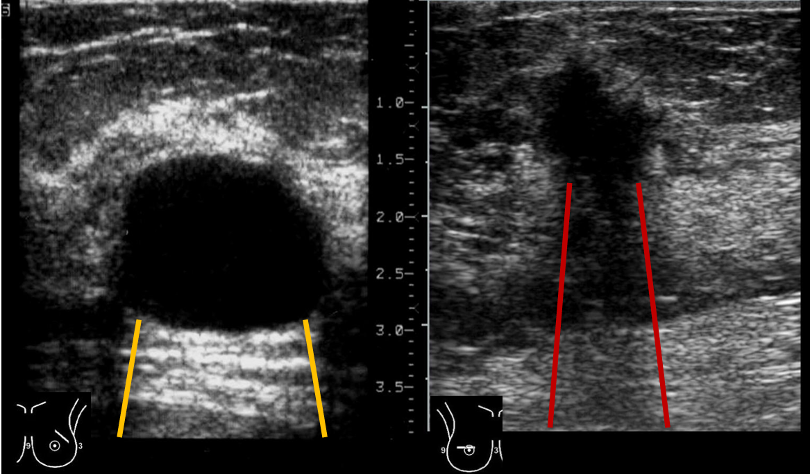 <p>Patient history: asymptomatic patients, complex breast screening studies </p><p>Modality: breast sonography with linear probe (7.5–10 MHz), B-mode </p><p>Region: Breast, axilla</p><p>Radiologic sign: left image – well-defined anechoic lesion with posterior acoustic enhancement (btw yellow lines); right image – ill-defined hypoechogenic lesion with partial acoustic shadowing (btw red lines), “taller than wide” solid mass, suspicious of cancer </p><p>Diagnosis: simple cyst / breast carcinoma</p>