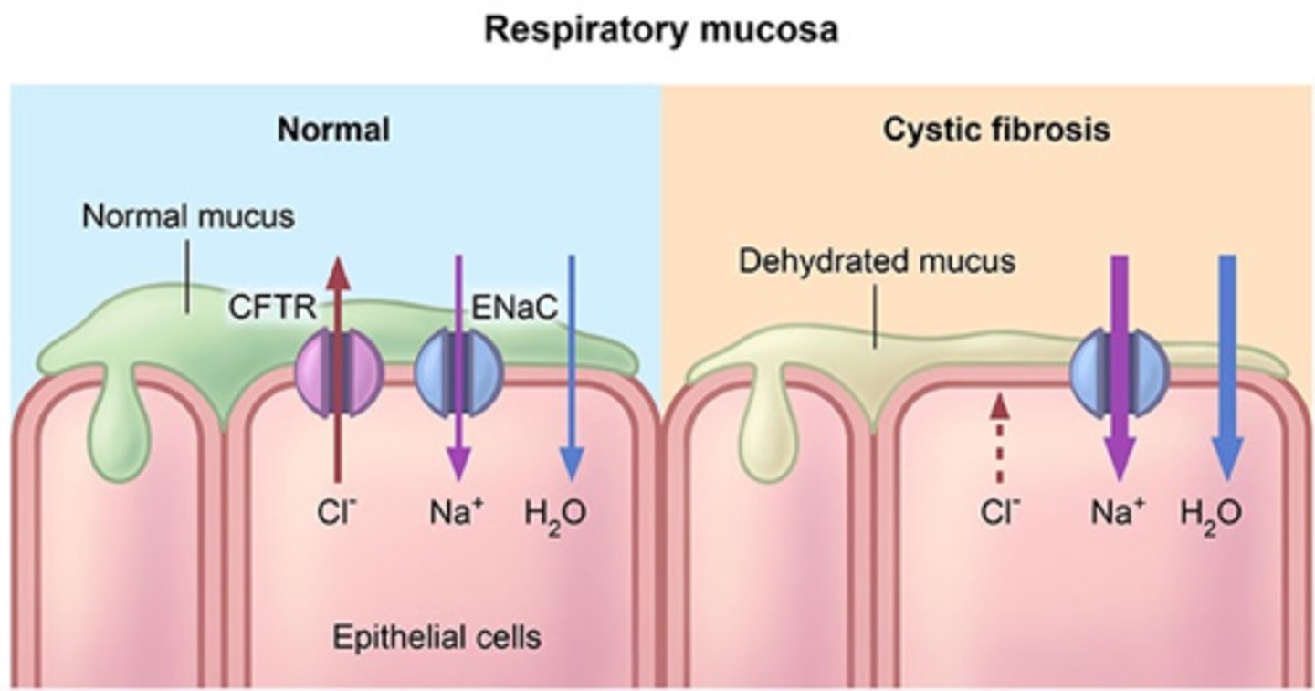 <p>cystic fibrosis is when there is a misfold of the delta F508 gene that causes the CFTR transporter (protein and ABC transporter) to not function properly</p><p>normal lungs have to be moist to allow cilia to flow and a wet lung surface is required to facilitate gas exchange</p><p>in normal (non-mutated gene)</p><p>-CFTR pumps Cl- ions out of the epithelial membrane</p><p>-due to higher concentration of Cl- out of the membrane, water diffuse through facilitated diffusion</p><p>-water diffusion keeps the surface of the cell (mucus layer) moist</p><p>-healthy lungs, good gas exchange, the vibes !</p><p>IF MUTATION:</p><p>-CFTR does not work, so no Cl- gradient will be formed</p><p>-water won't follow the gradient through diffusion (bcz there is no gradient)</p><p>-mucus layer remains dry</p><p>-bad gas exchange</p><p>-higher chance of lung infections because you won't be able to cough the bad shit!</p>