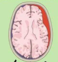 <p>Type of Hemorrhagic stroke with bleeding into the subarachnoid space, where cerebrospinal fluid (CSF) circulates. Secondary headache</p>