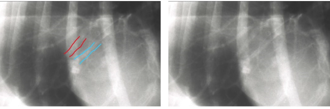 <ol><li><p>too much circulation - fluid overload - left to right shunt</p></li><li><p>too little circulation e.g. hypovolaemia - R → L shunt</p><ul><li><p>lungs look less white - seeing vessels is normal, if they’re small it will be less white, more black on the radiograph</p></li></ul></li></ol><p></p>