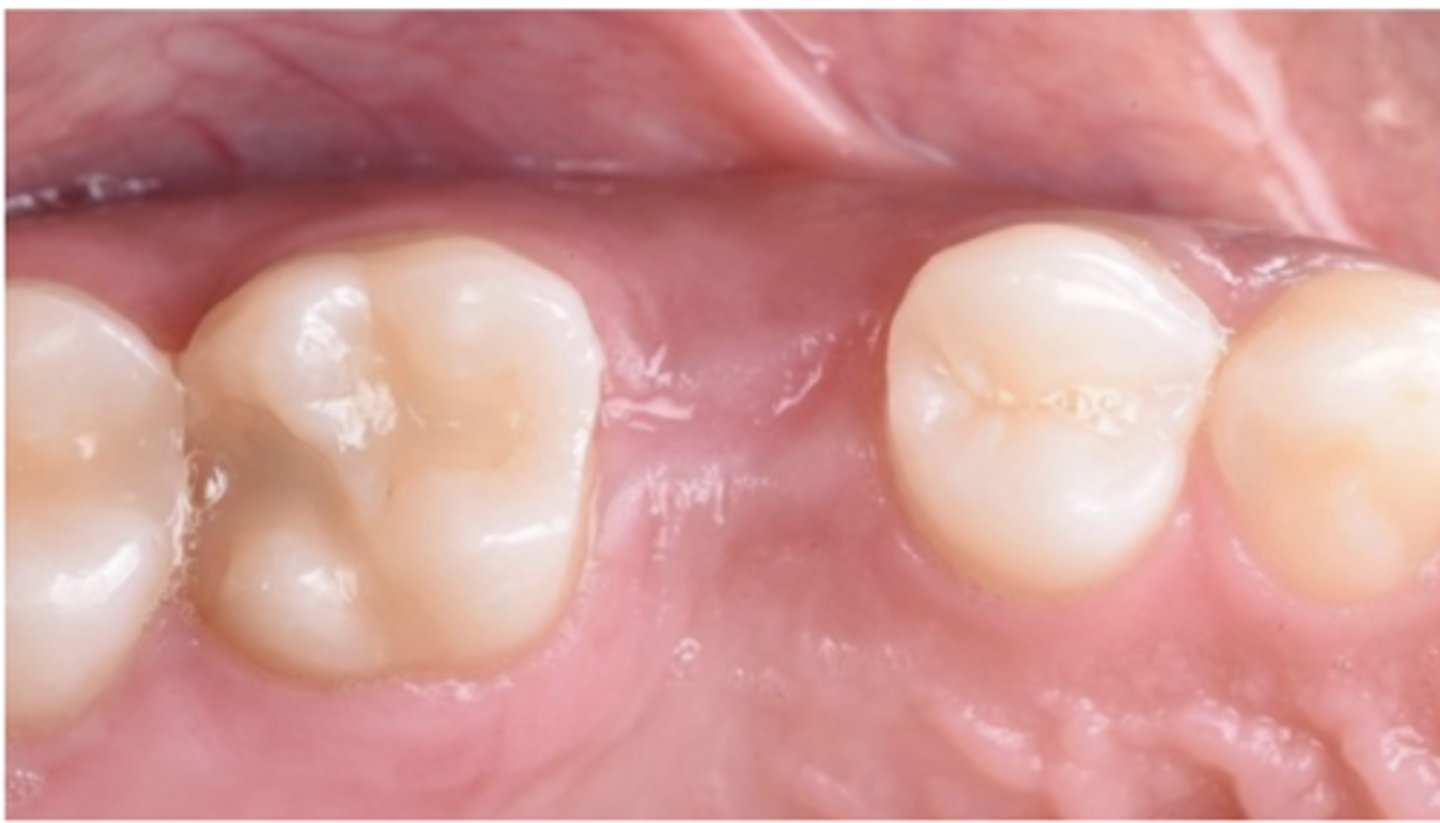 <p>Based on the provided figure, you are planning to place a dental implant on #4. When you measure the mesio-distal space, how much space you need to have in order to make sure you have safely place implant ?</p><p>a. 5 mm</p><p>b. 6 mm</p><p>c. 7 mm</p><p>d. 8 mm</p><p>e. 9 mm</p>